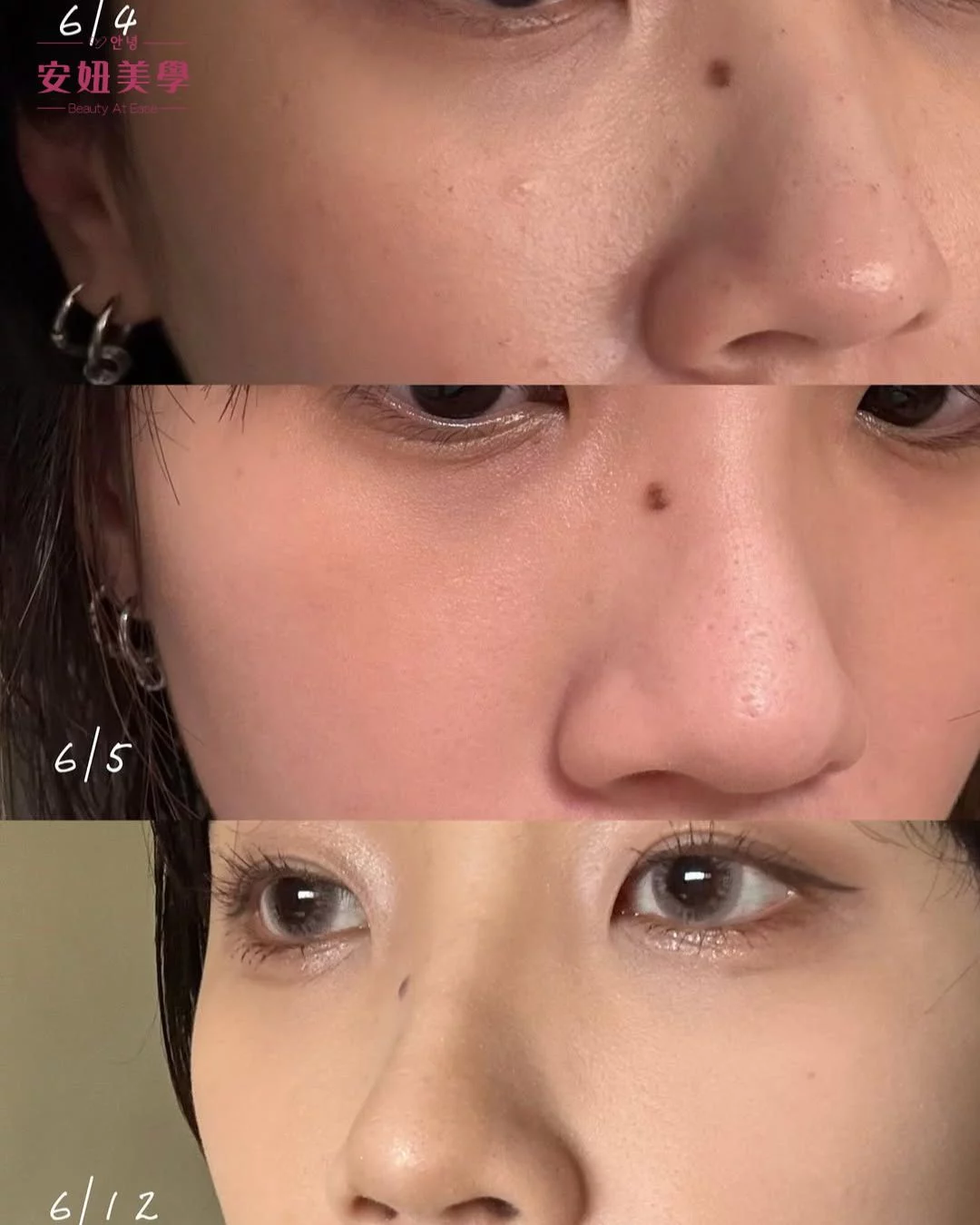 佳儀皮秒苓雅林姿吟5