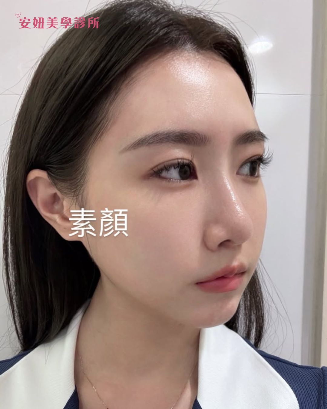 「星皮秒保養+肉毒調整，整個人亮了起來」 Ft.曉曉 | 陳嘉珊醫師